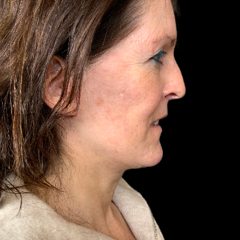 after-deep-plane-facelift-necklift-liplift-nanofat